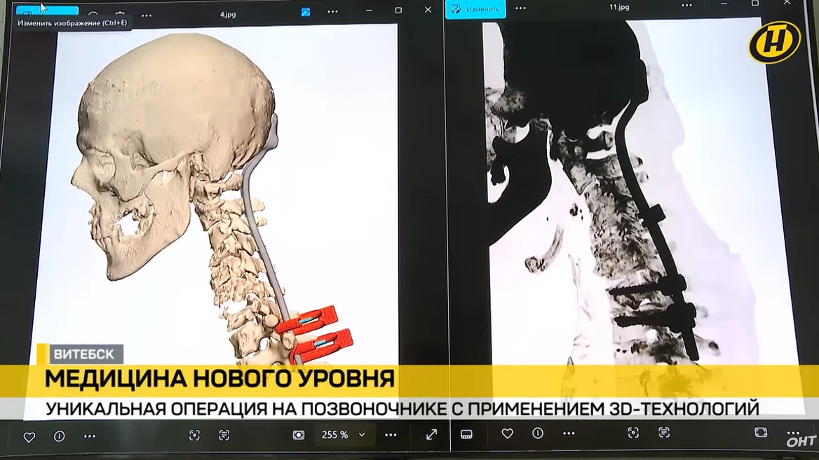 Витебские хирурги поставили на ноги парализованного пациента с помощью распечатанного импланта
