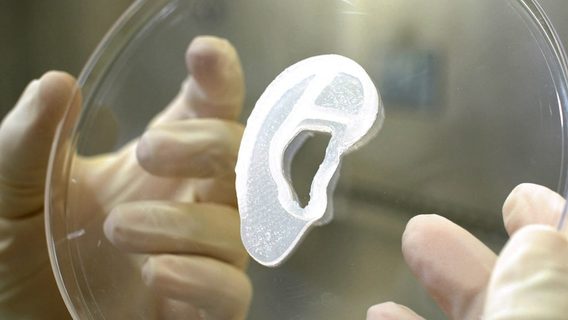 Врачи пересадили пациентке ухо, напечатанное из её собственных клеток на 3D-принтере 