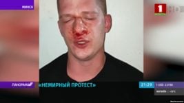 Айтишник, гражданин России, попал в госпиталь и на БТ — в сюжет «Немирный протест»